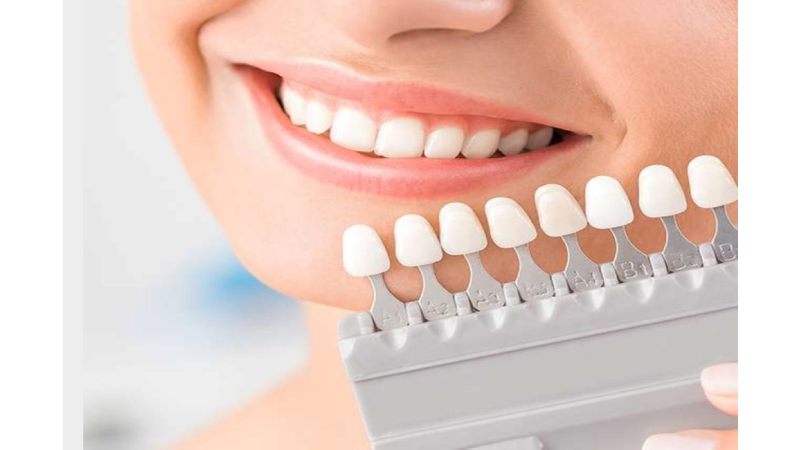 Veneer Teeth Write For Us